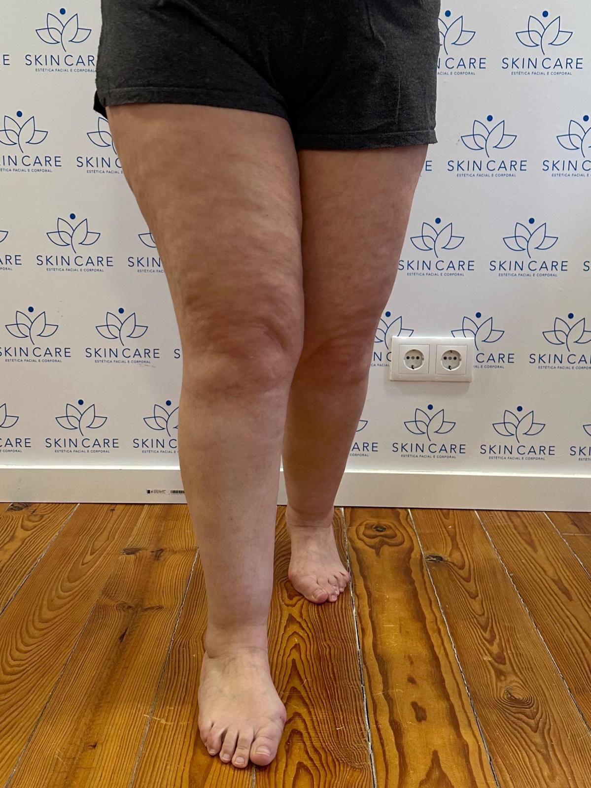 Mulher com desconforto e sensação de peso nas pernas