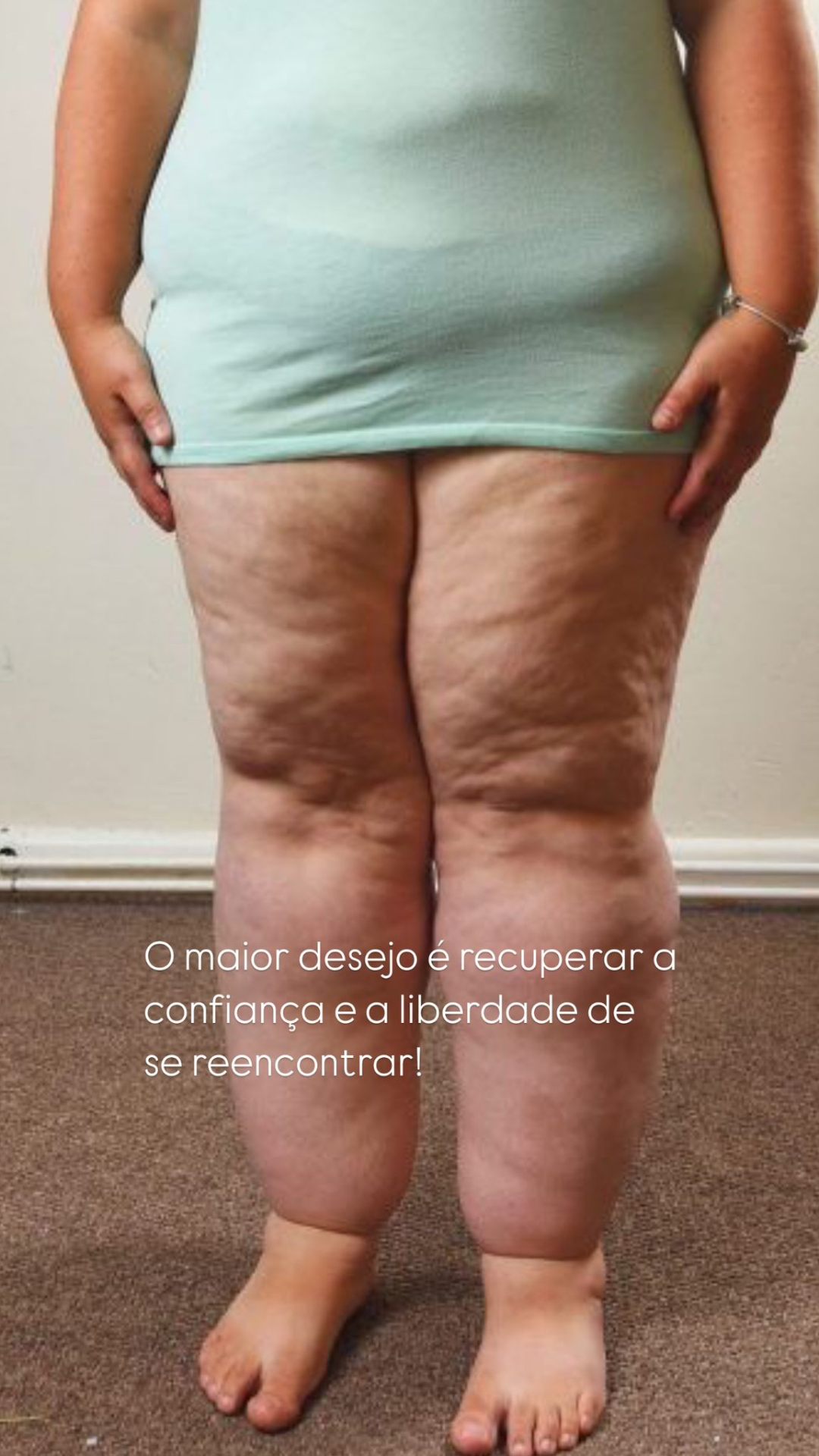 Mulher com desconforto e sensação de peso nas pernas